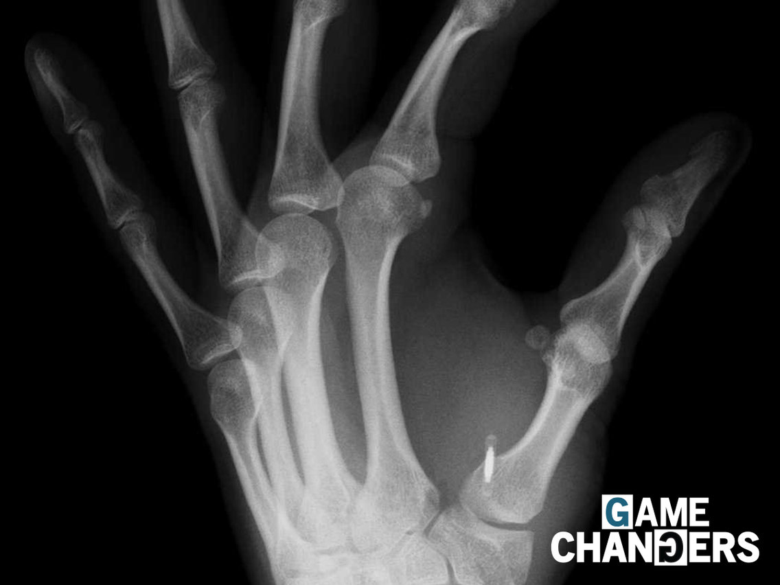 Рентген кисти руки с имплантатом